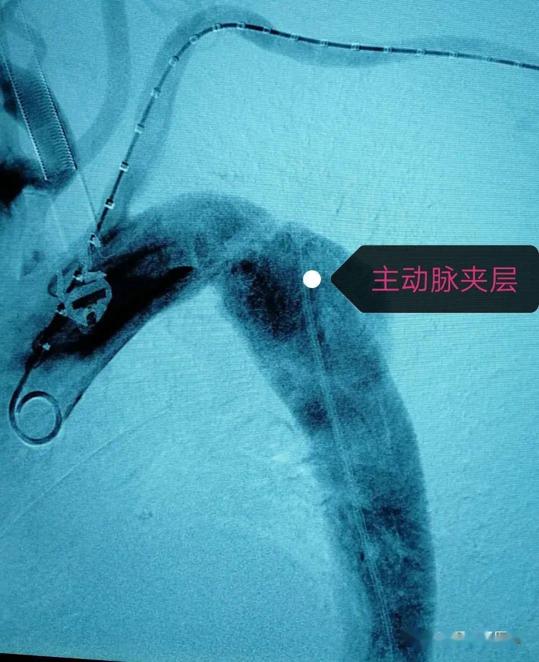 胸主动脉覆膜支架产品价格重新制定,惠泰医疗回应