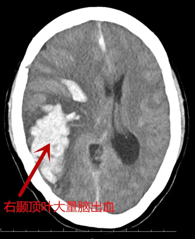 生死竞速！成都东部新区中西医结合医院成功抢救一名颅脑外伤、脑疝致呼吸心脏停搏患者