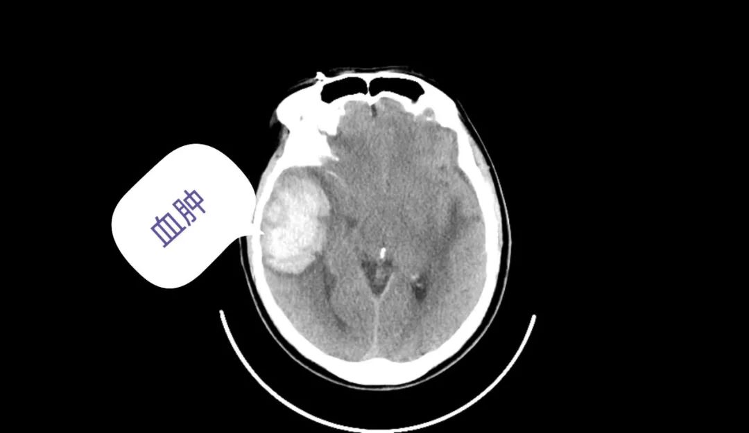 生死竞速！成都东部新区中西医结合医院成功抢救一名颅脑外伤、脑疝致呼吸心脏停搏患者